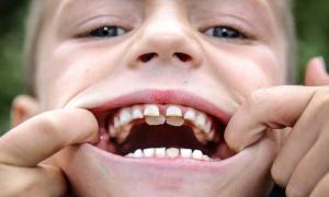Haber perdido un diente de leche según el libro de los sueños: el sueño de un niño de haber perdido un diente por la sangre'ю